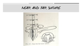 NEAR AND FAR SUTURE
 
