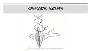 CRUCIATE SUTURE
 
