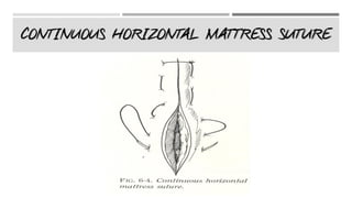 CONTINUOUS HORIZONTAL MATTRESS SUTURE
 