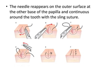 • The needle reappears on the outer surface at
the other base of the papilla and continuous
around the tooth with the sling suture.
 
