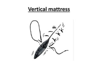 Vertical mattress
 