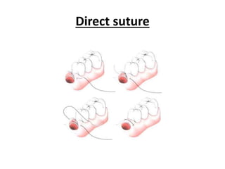 Direct suture
 