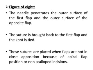 Figure of eight:
• The needle penetrates the outer surface of
the first flap and the outer surface of the
opposite flap.
• The suture is brought back to the first flap and
the knot is tied.
• These sutures are placed when flaps are not in
close apposition because of apical flap
position or non scalloped incisions.
 
