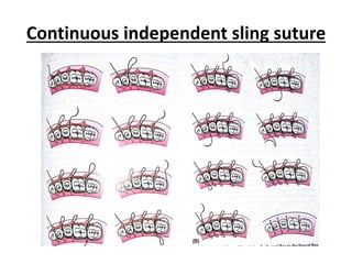 Continuous independent sling suture
 