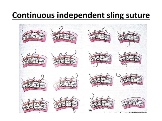 Suturing techniques ppt | PPTX | First Aid | Injuries