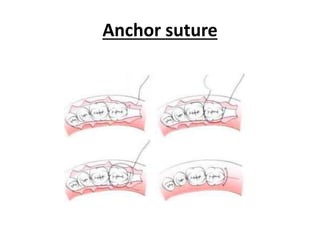 Anchor suture
 