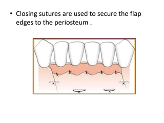 • Closing sutures are used to secure the flap
edges to the periosteum .
 