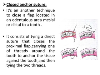 Anchoring suture 2024