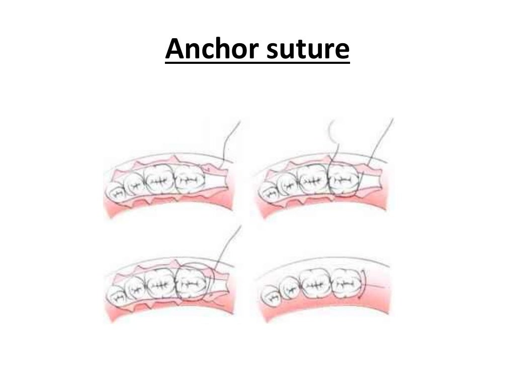 Suturing techniques ppt