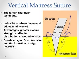 Vertical Mattress Suture
• The far far, near near
technique.
• Indications: where the wound
edges tend to evert
• Advantages: greater closure
strength and better
distribution of wound tension
• Disadvantages: Scar formation
and the formation of edge
necrosis.
 
