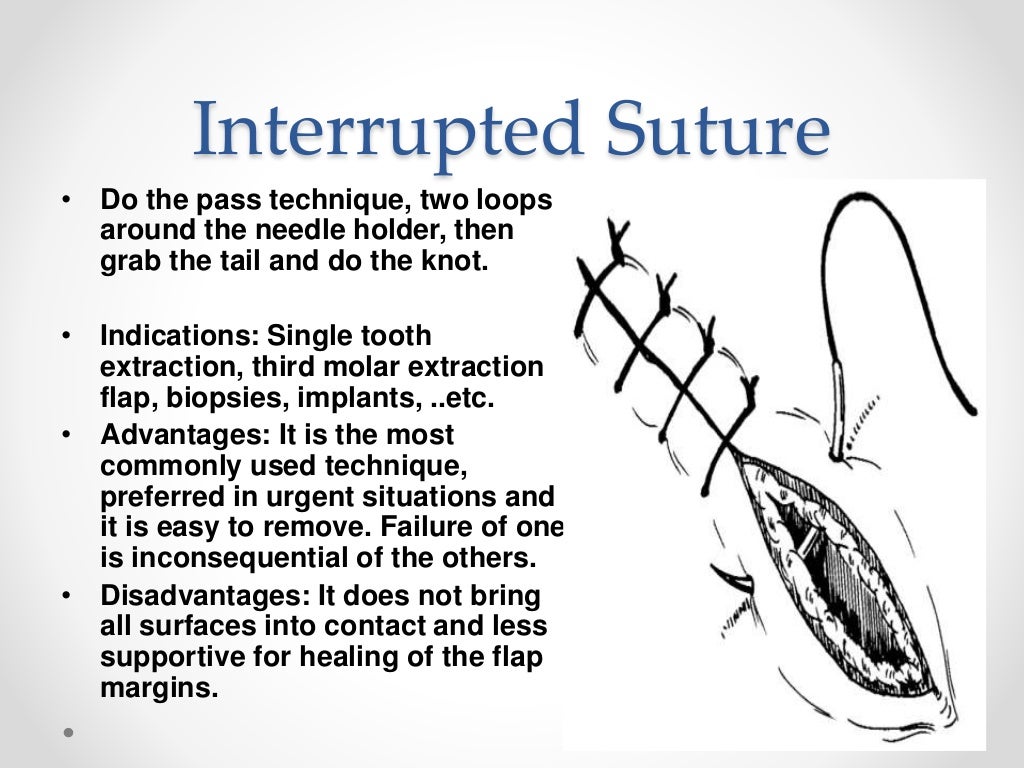 Suturing techniques involved in dental surgery