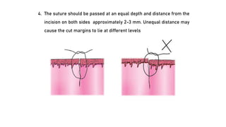 4. The suture should be passed at an equal depth and distance from the
incision on both sides approximately 2-3 mm. Unequal distance may
cause the cut margins to lie at different levels
 