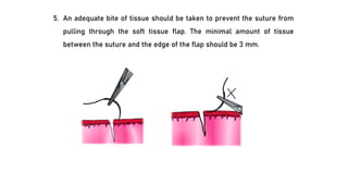 5. An adequate bite of tissue should be taken to prevent the suture from
pulling through the soft tissue flap. The minimal amount of tissue
between the suture and the edge of the flap should be 3 mm.
 