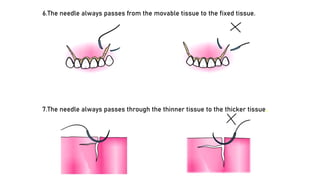 6.The needle always passes from the movable tissue to the fixed tissue.
7.The needle always passes through the thinner tissue to the thicker tissue.
 