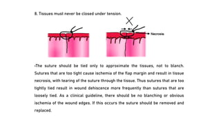 8. Tissues must never be closed under tension.
•The suture should be tied only to approximate the tissues, not to blanch.
Sutures that are too tight cause ischemia of the flap margin and result in tissue
necrosis, with tearing of the suture through the tissue. Thus sutures that are too
tightly tied result in wound dehiscence more frequently than sutures that are
loosely tied. As a clinical guideline, there should be no blanching or obvious
ischemia of the wound edges. If this occurs the suture should be removed and
replaced.
 