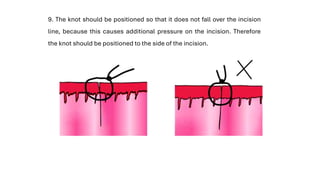 9. The knot should be positioned so that it does not fall over the incision
line, because this causes additional pressure on the incision. Therefore
the knot should be positioned to the side of the incision.
 