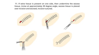 11. If extra tissue is present on one side, then undermine the excess
tissue, incise at approximately 30 degree angle, excess tissue is placed
over incision and excised, incision sutured.
 