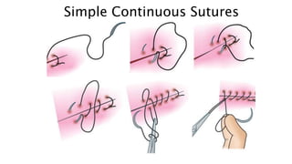 Simple Continuous Sutures
•
– .
 