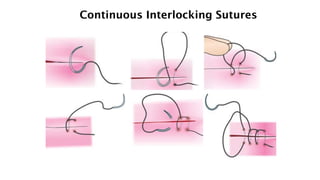 Continuous Interlocking Sutures
 