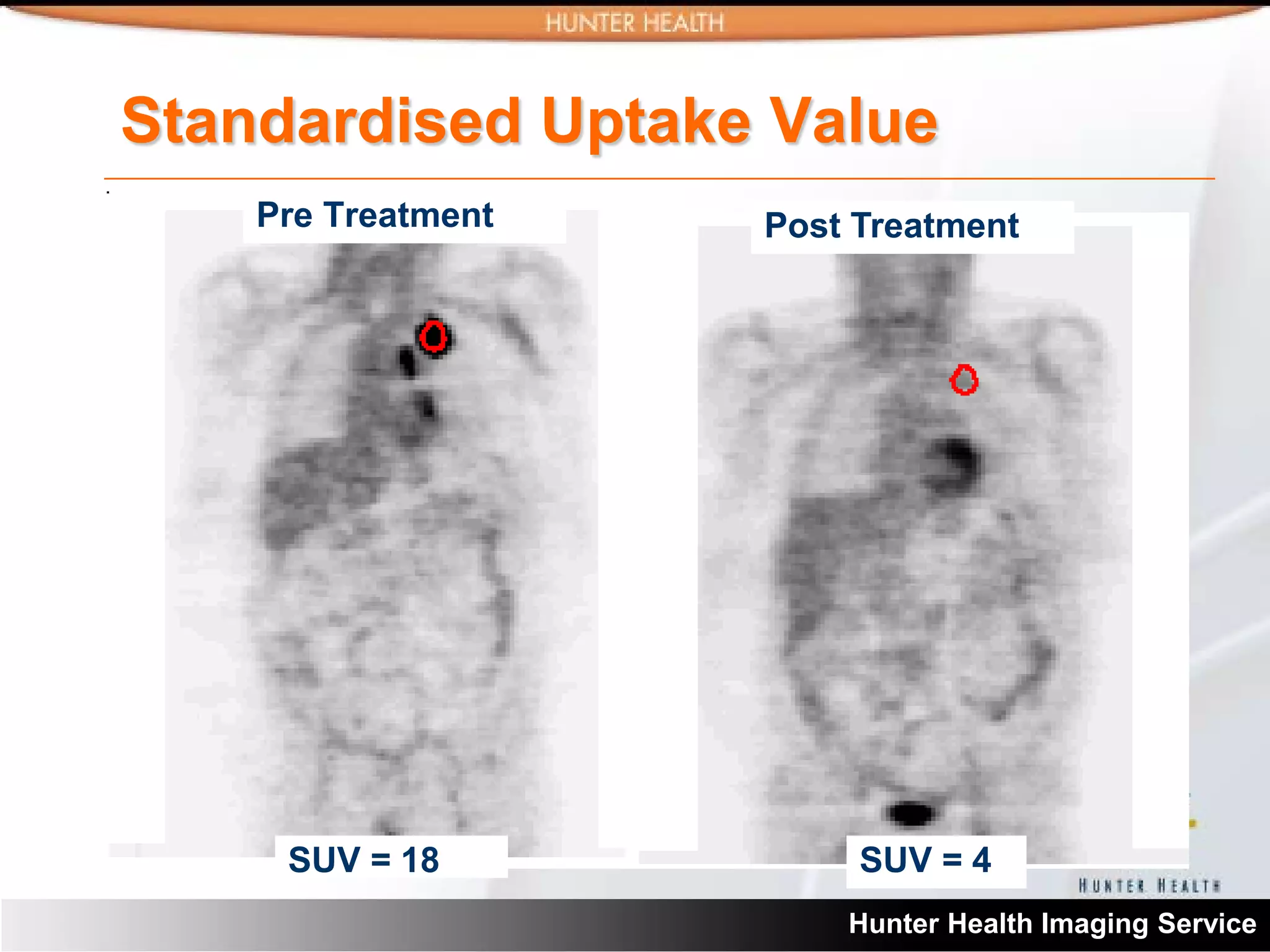 SUV- standardised uptake values in pet scanning | PDF