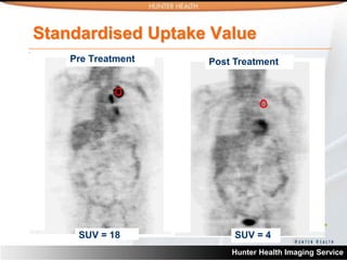 Standardised Uptake Value
    Pre Treatment   Post Treatment




     SUV = 18            SUV = 4
                        Hunter Health Imaging Service
 