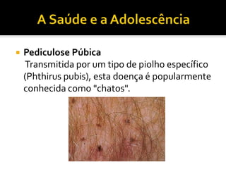 A Saúde e a AdolescênciaHerpes VaginalDoença dolorosa e episódica. Pode ser tratada, mas não tem cura definitiva e tem tendência a repetir-se.