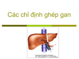 Các chỉ định ghép gan
 