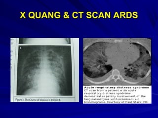 X QUANG & CT SCAN ARDSX QUANG & CT SCAN ARDS
 