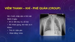 VIÊM THANH – KHÍ - PHẾ QUẢN (CROUP)
Nữ, 2 tuổi, nhập viện vì thở mệt
Bệnh 3 ngày:
• N1-2: Sốt nhẹ, ho, sổ mũi
• N3: Khàn giọng, thở mệt, bú ít
Khám:
• Thở rít / nằm yên
• Khàn tiếng / khóc
 