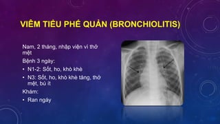 VIÊM TIỂU PHẾ QUẢN (BRONCHIOLITIS)
Nam, 2 tháng, nhập viện vì thở
mệt
Bệnh 3 ngày:
• N1-2: Sốt, ho, khò khè
• N3: Sốt, ho, khò khè tăng, thở
mệt, bú ít
Khám:
• Ran ngáy
 