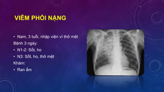 VIÊM PHỔI NẶNG
• Nam, 3 tuổi, nhập viện vì thở mệt
Bệnh 3 ngày:
• N1-2: Sốt, ho
• N3: Sốt, ho, thở mệt
Khám:
• Ran ẩm
 