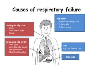 Đường hô hấp trên:
- Dị vật
- Viêm thanh thiệt
- Croup
Đường hô hấp dưới:
- Viêm phổi
- Viêm tiểu phế quản
- Hen phế quản
- Bệnh lý màng phổi
Thần kinh:
- Viêm não- màng não
- Xuất huyết
- Chấn thương
Tim:
Suy tim, TDMN tim
Độc chất
 