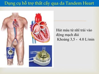 
Dụng cụ hỗ trợ thất cấy qua da Tandem Heart
Hút máu từ nhĩ trái vào
động mạch đùi
Khoảng 3,5 - 4.0 L/min
 