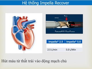 Hệ thống Impella Recover
Impella® 2.5 Impella® 5.0
2.5 L/min 5.0 L/Min
Hút máu từ thất trái vào động mạch chủ
 