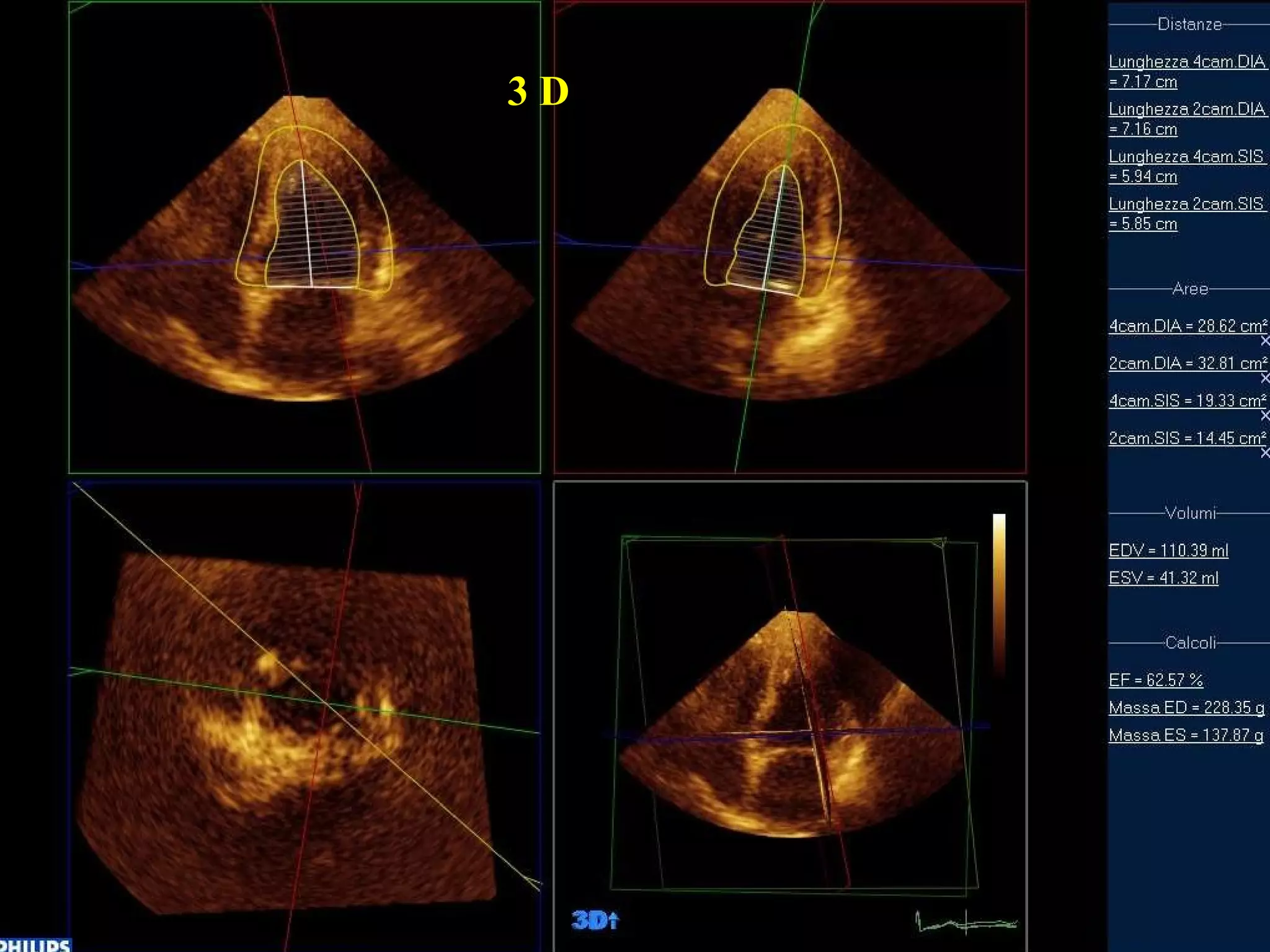 Stenosi Valvolare Aortica SVA Valutazione Ecocardiografica PPT stenosi-valvolare-aortica-sva-valutazione-ecocardiografica-ppt