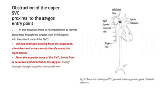 Obstruction of the upper
SVC
proximal to the azygos
entry point
.  In this situation, there is no impediment to normal
blood flow through the azygos vein which opens
into the patent tract of the SVC.
 Venous drainage coming from the head neck,
shoulders and arms cannot directly reach the
right atrium.
 From the superior tract of the SVC, blood flow
is reversed and directed to the azygos, mainly
through the right superior intercostal vein.
 