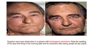 Superior vena cava obstruction in a person with brochogenic carcinoma. Note the swelling
of his face first thing in the morning (left) and its resolution after being upright all day (right).
 