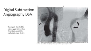 Digital Subtraction
Angiography DSA
DSA is gold standard to
assess upper extremities
thrombosis an widely
available in most Centre
 