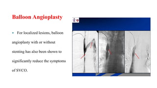 Balloon Angioplasty
 For localized lesions, balloon
angioplasty with or without
stenting has also been shown to
significantly reduce the symptoms
of SVCO.
 