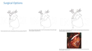 Surgical Options
 