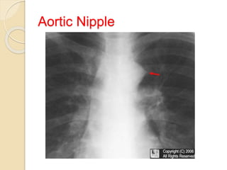 Aortic Nipple
 
