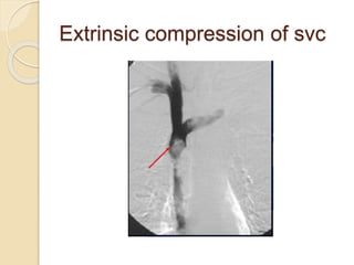 Extrinsic compression of svc
 