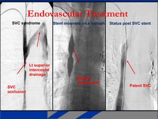 Endovascular Treatment
SVC syndrome
Lt superior
intercostal
drainage
SVC
occlusion
Stent mounted on a balloon Status post SVC stent
Balloon
deployment
Patent SVC
 