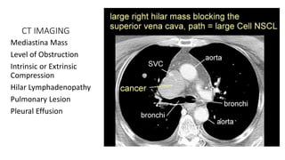 CT IMAGING
Mediastina Mass
Level of Obstruction
Intrinsic or Extrinsic
Compression
Hilar Lymphadenopathy
Pulmonary Lesion
Pleural Effusion
 