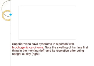 Superior vena cava syndrome in a person with
brochogenic carcinoma. Note the swelling of his face first
thing in the morning (left) and its resolution after being
upright all day (right).
 