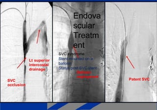 Lt superior
intercostal
drainage
SVC
occlusion
Endova
scular
Treatm
ent
SVC syndrome
Stent mounted on a
balloon
Status post SVC stent
Balloon
deployment
Patent SVC
 