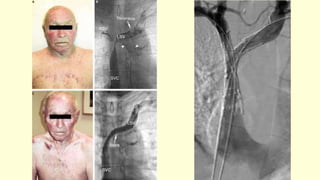 Svc Rupture SVC syndrome - a surgical perspective | PPTX