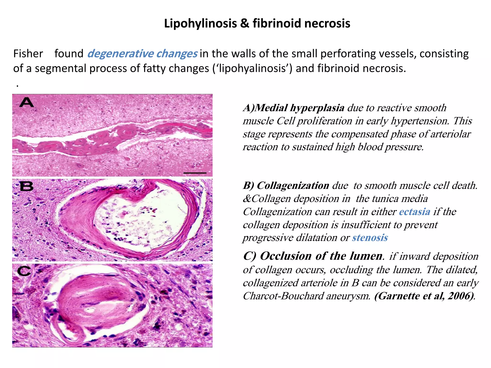 Small Vessel Disease | PDF