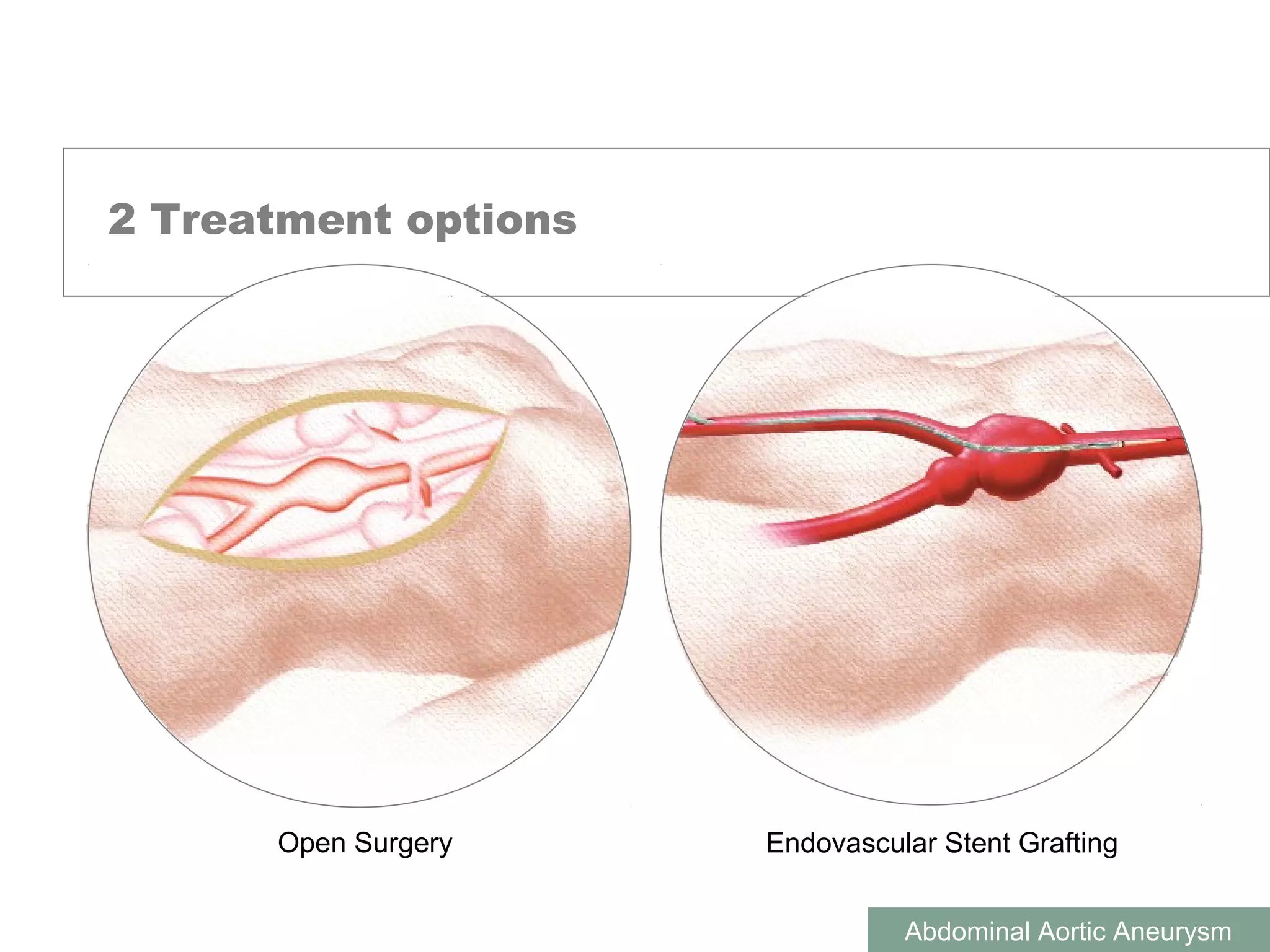 Abdominal Aortic Aneurysm | PPT