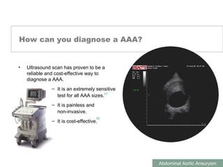 ABDOMINAL AORTIC ANEURYSMS
Abdominal Aortic Aneurysm
How can you diagnose a AAA?
• Ultrasound scan has proven to be a
reliable and cost-effective way to
diagnose a AAA.
– It is an extremely sensitive
test for all AAA sizes.
– It is painless and
non-invasive.
– It is cost-effective.
31
32
 